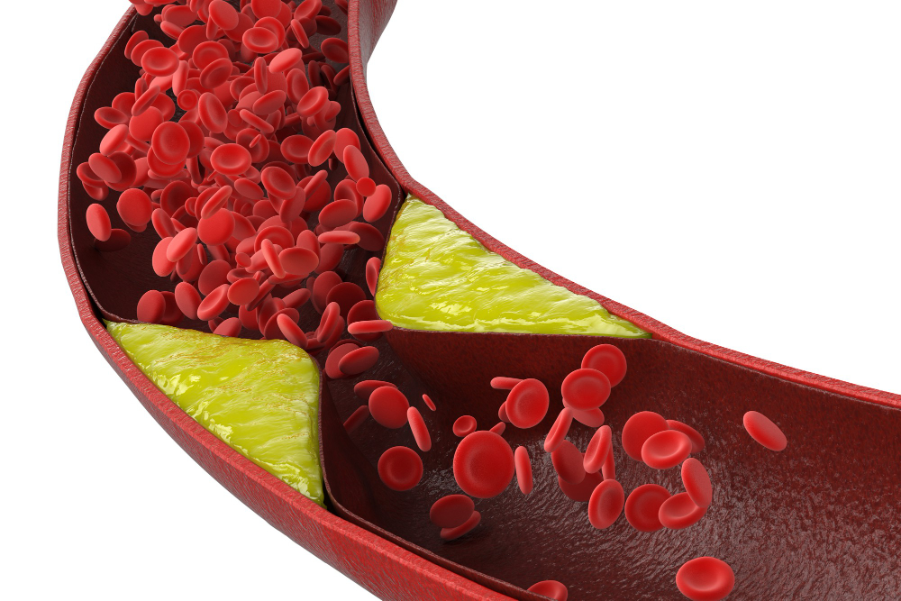 ilustrasi kolesterol tinggi di pembuluh darah